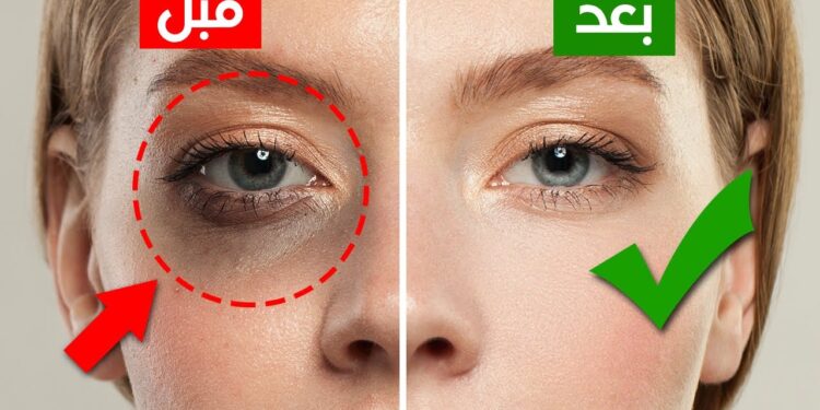 التخلص من الهالات السوداء بسهولة مع هذا الماسك الفعال