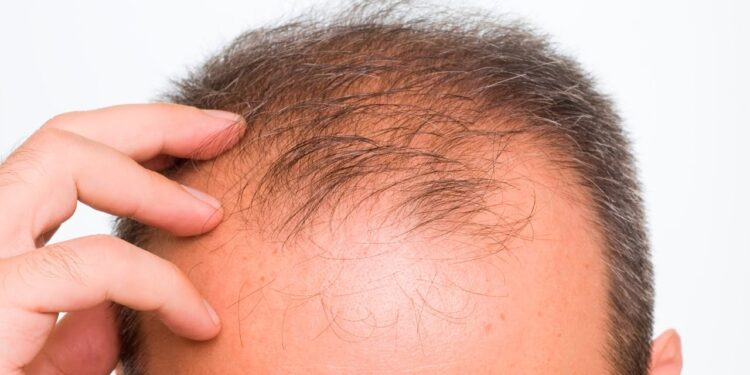 البذور وعلاج الصلع الوراثي مفاجآت علمية جديدة لتعزيز نمو الشعر 1 البذور وعلاج الصلع الوراثي مفاجآت علمية جديدة لتعزيز نمو الشعر