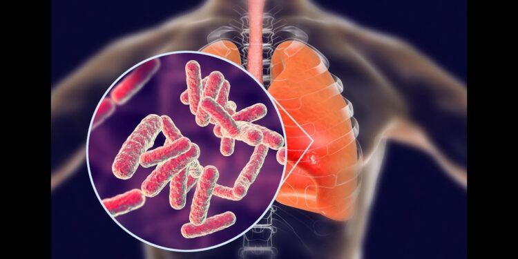 مرض السل ينتشر بشكل غير مسبوق في ولاية أمريكية