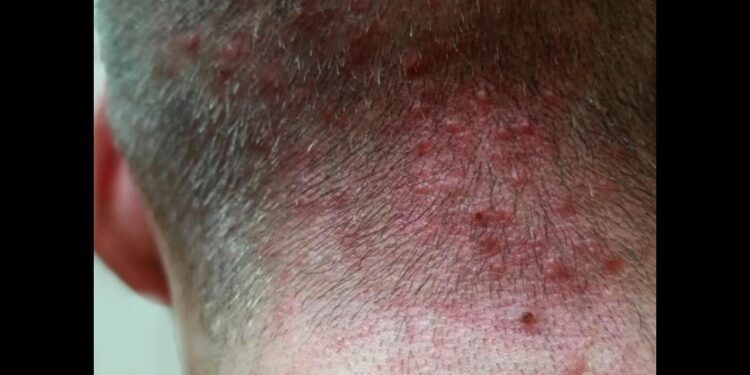 أفضل طرق علاج حبوب فروة الرأس حسب الأسباب المؤدية لها 1 أفضل طرق علاج حبوب فروة الرأس حسب الأسباب المؤدية لها