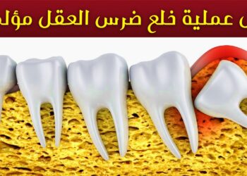 متى يحتاج الشخص إلى خلع أضراس العقل؟
