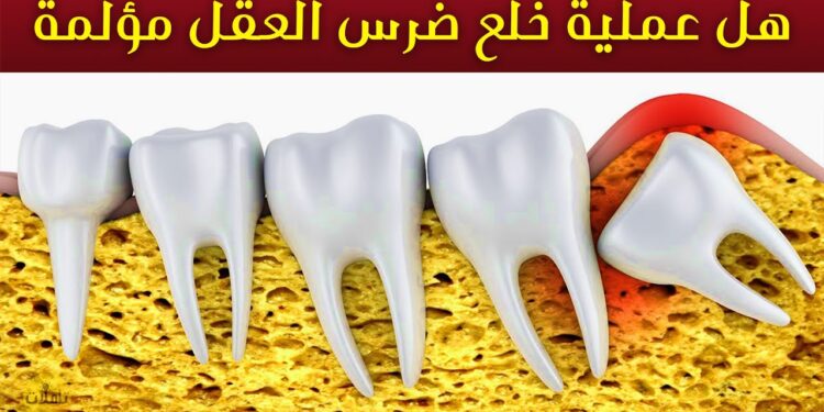 متى يحتاج الشخص إلى خلع أضراس العقل؟