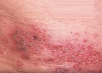 في خبر عاجل: مرض معدي جديد يظهر في أمريكا وأول إصابة تم تسجيلها