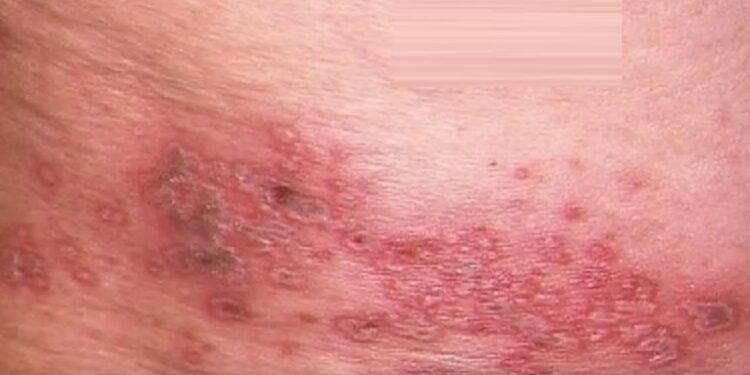 في خبر عاجل: مرض معدي جديد يظهر في أمريكا وأول إصابة تم تسجيلها