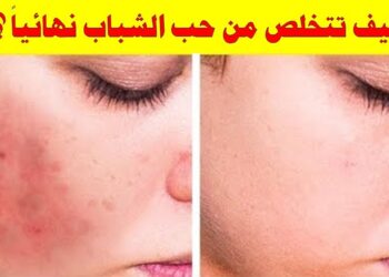 حب الشباب مشكلة؟ إليك الحل السحري الفعال منذ أول استخدام