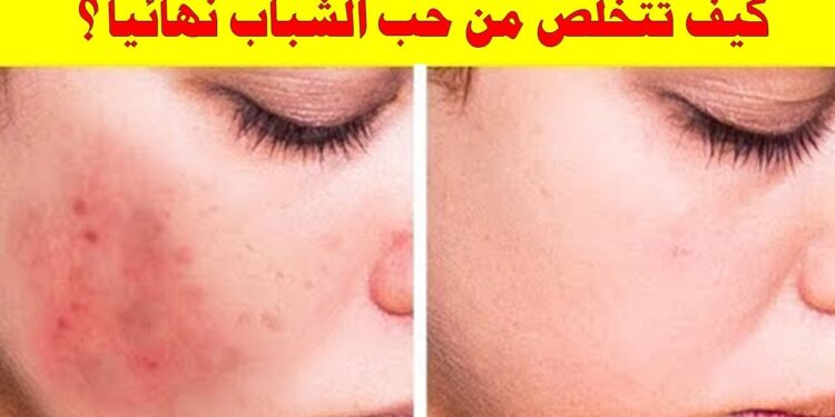 حب الشباب مشكلة؟ إليك الحل السحري الفعال منذ أول استخدام 1 حب الشباب مشكلة؟ إليك الحل السحري الفعال منذ أول استخدام