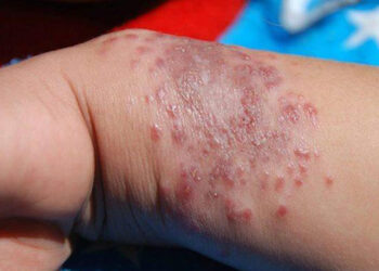 فيروس شائع الاستخدام يساعد في التصدي لسرطان الجلد