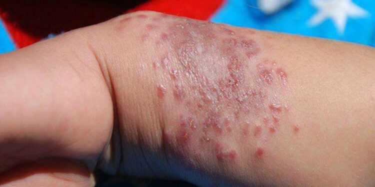 فيروس شائع الاستخدام يساعد في التصدي لسرطان الجلد 1 فيروس شائع الاستخدام يساعد في التصدي لسرطان الجلد