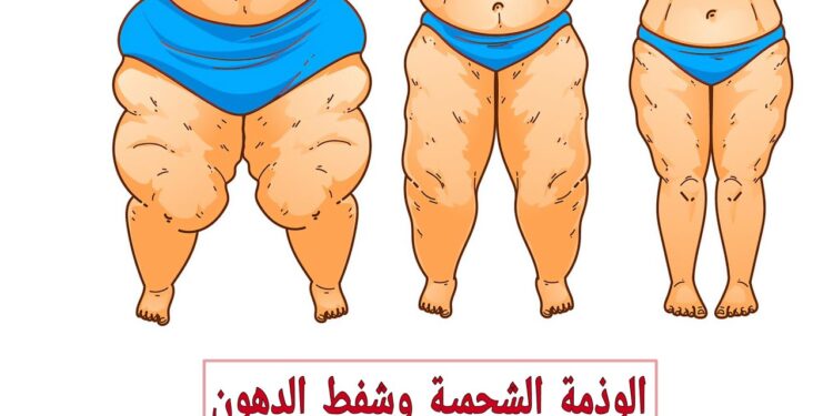 الوذمة خطر يهدد صحتك.. تحذيرات من خبيرة مختصة