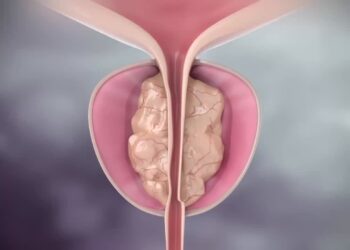ورم البروستاتا الحميد بين المعلومة والخرافة رأي طبي يوضح