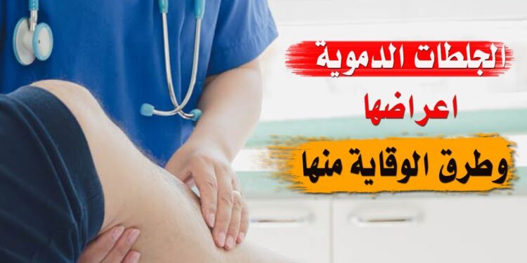 نقلة نوعية في الطب الحديث لعلاج الجلطات الدموية بدون مضاعفات 1 نقلة نوعية في الطب الحديث لعلاج الجلطات الدموية بدون مضاعفات