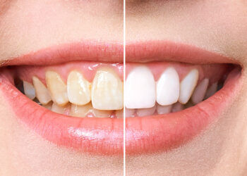 تبييض الأسنان سريعًا دون مواد كيميائية.. الحل في مطبخك