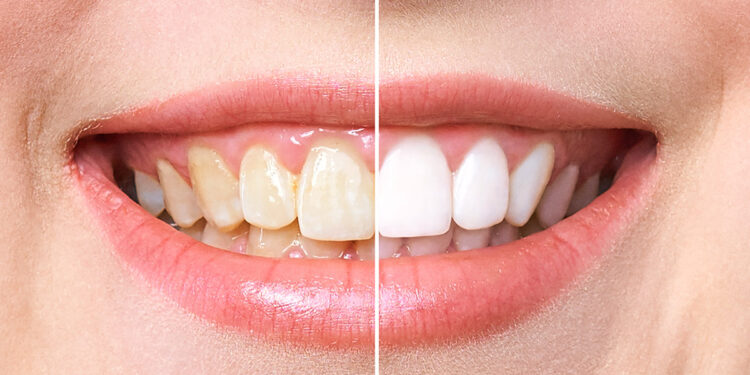 تبييض الأسنان سريعًا دون مواد كيميائية.. الحل في مطبخك 1 تبييض الأسنان سريعًا دون مواد كيميائية.. الحل في مطبخك