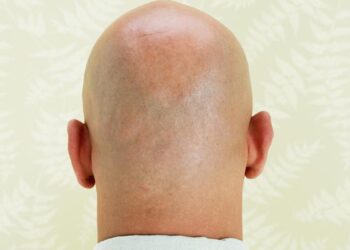 هل تعلم؟ هذا العامل قد يكون وراء إصابتك بالصلع