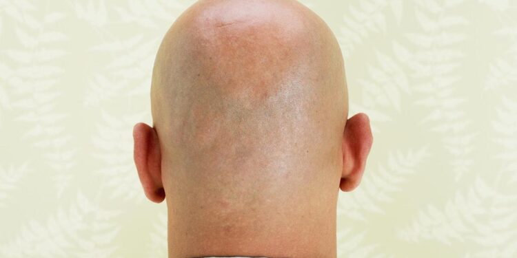 هل تعلم؟ هذا العامل قد يكون وراء إصابتك بالصلع 1 هل تعلم؟ هذا العامل قد يكون وراء إصابتك بالصلع