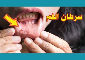 السرطان المبكر للفم علامات غير مؤلمة وغير ملحوظة