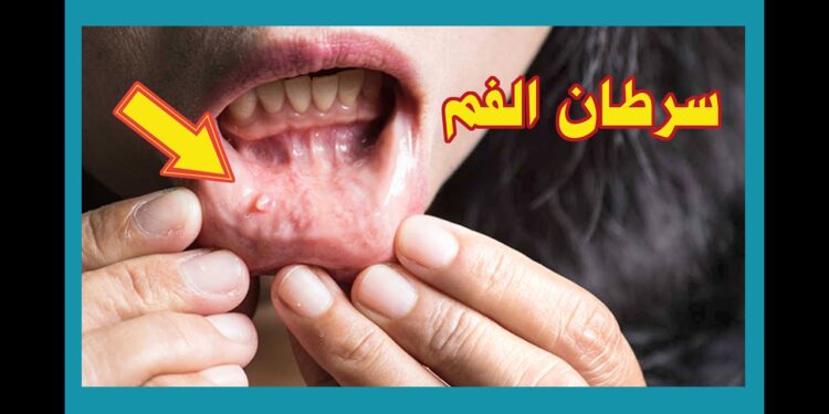 السرطان المبكر للفم علامات غير مؤلمة وغير ملحوظة 1 السرطان المبكر للفم علامات غير مؤلمة وغير ملحوظة