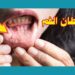 السرطان المبكر للفم علامات غير مؤلمة وغير ملحوظة 2 السرطان المبكر للفم علامات غير مؤلمة وغير ملحوظة
