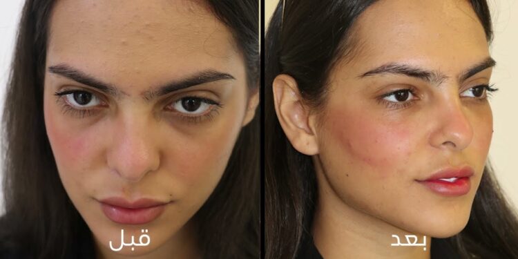 بدائل الفيلر الطبيعية.. وصفة فعالة لنفخ الخدود وإبراز جمال الوجه