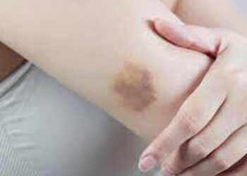 البقع الزرقاء على الجسم علامة على مشكلات صحية خطيرة