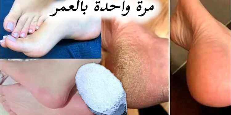 وصفة منزلية مجربة للقضاء على تشققات الكعبين وسواد القدم خلال يوم 1 وصفة منزلية مجربة للقضاء على تشققات الكعبين وسواد القدم خلال يوم