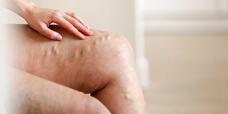 كيفية حماية الساقين من تطور الدوالي 1 كيفية حماية الساقين من تطور الدوالي